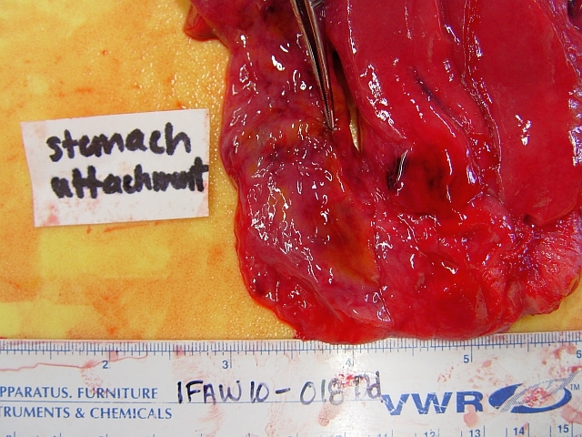 Hemorrhagic Pancreas