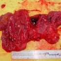 Hemorrhagic Pancreas