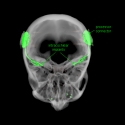 Human Cochlear Implant
